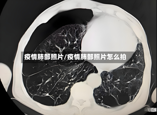 疫情肺部照片/疫情肺部照片怎么拍