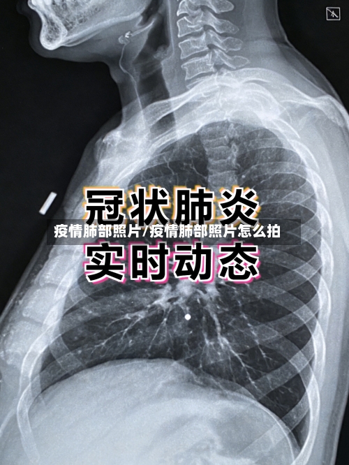 疫情肺部照片/疫情肺部照片怎么拍-第2张图片