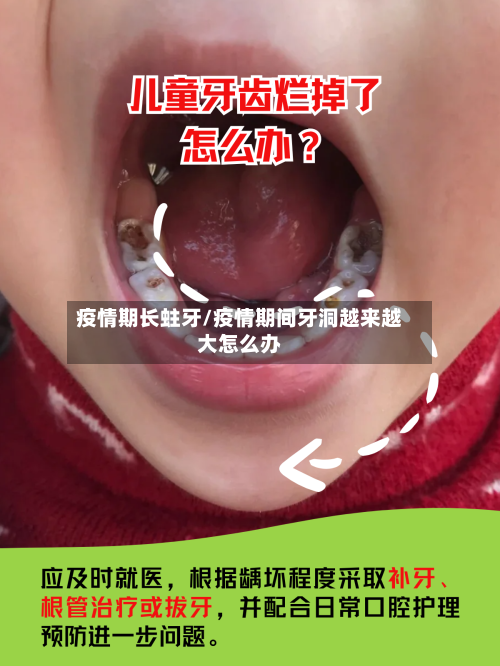 疫情期长蛀牙/疫情期间牙洞越来越大怎么办-第3张图片