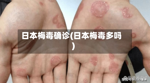 日本梅毒确诊(日本梅毒多吗)-第3张图片