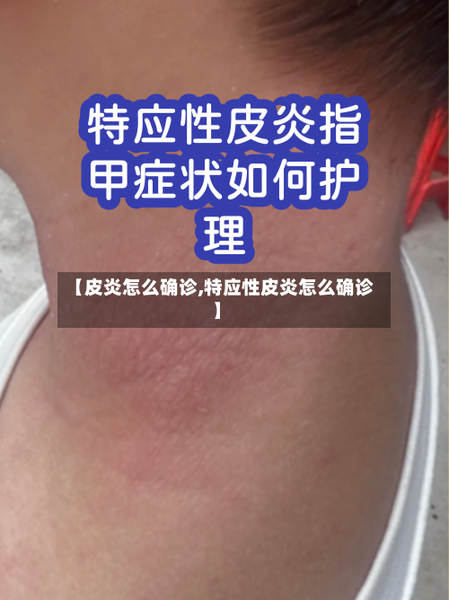 【皮炎怎么确诊,特应性皮炎怎么确诊】