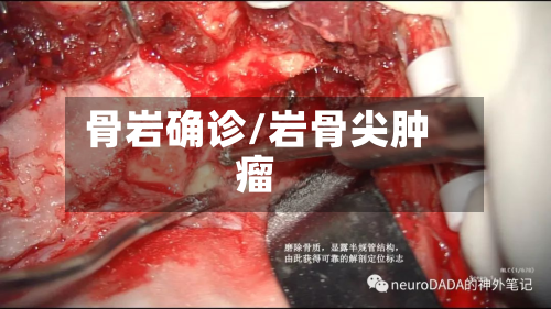 骨岩确诊/岩骨尖肿瘤