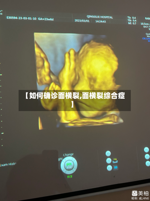 【如何确诊面横裂,面横裂综合症】-第3张图片
