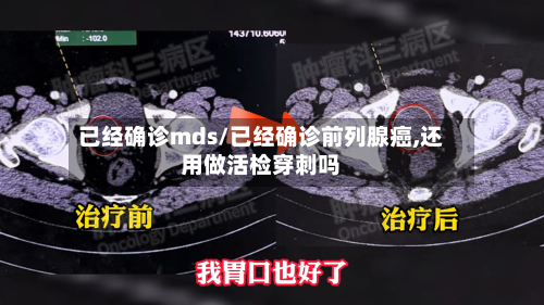 已经确诊mds/已经确诊前列腺癌,还用做活检穿刺吗-第2张图片