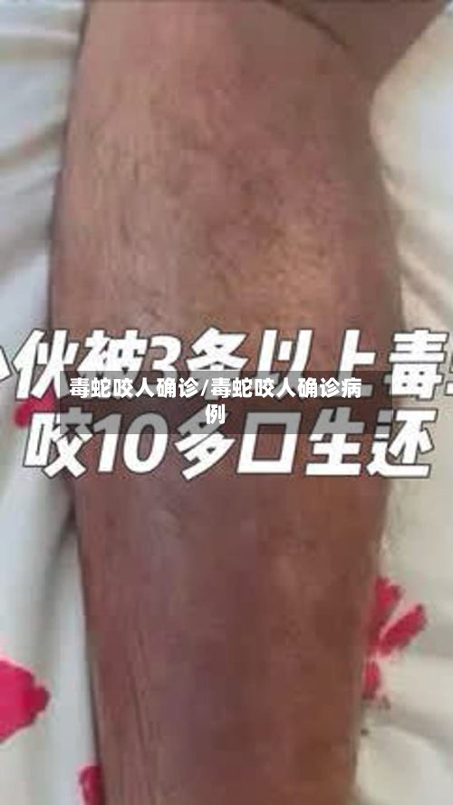 毒蛇咬人确诊/毒蛇咬人确诊病例