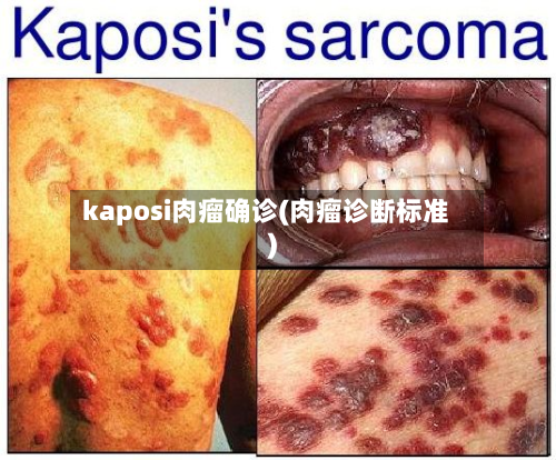 kaposi肉瘤确诊(肉瘤诊断标准)